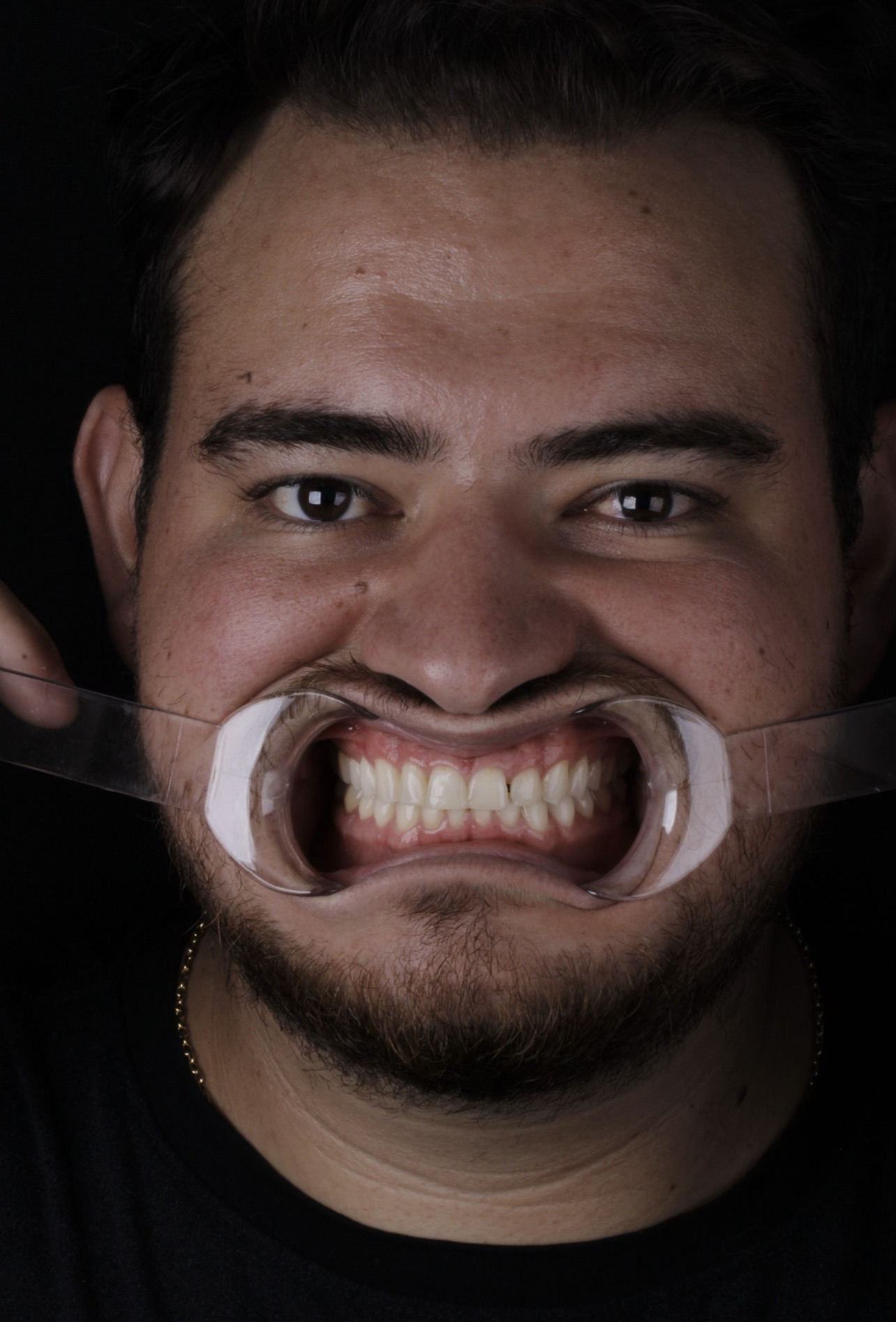 Reabilitação estética superior — antes